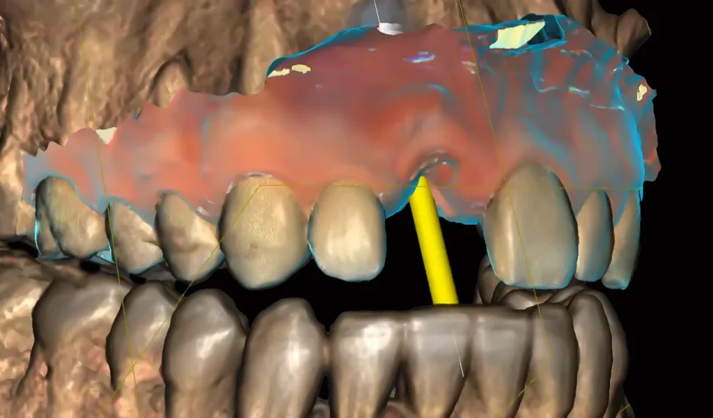 best dental implants placement