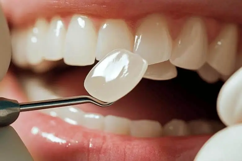 same day crowns (cerec) process in Esthetic Dentistry