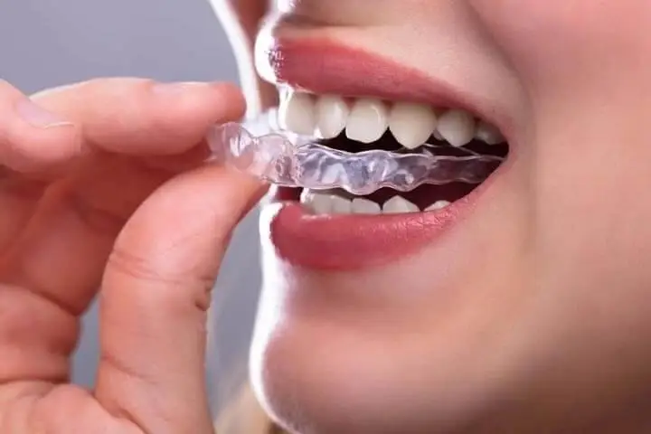 suresmile clear aligners