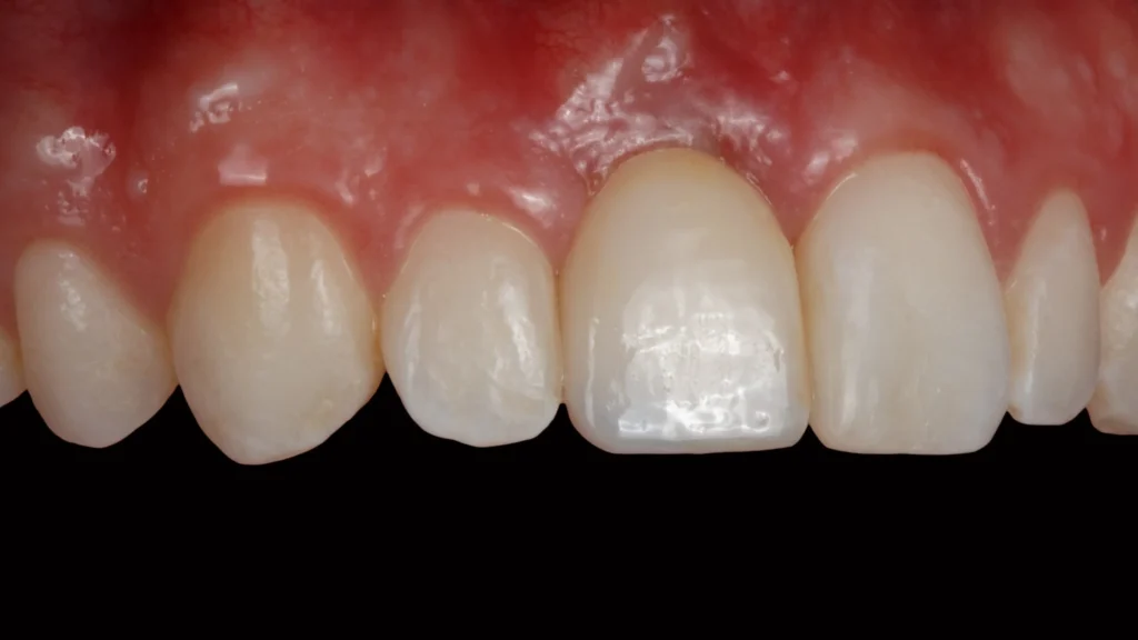 After Image - Healing Dental implants process