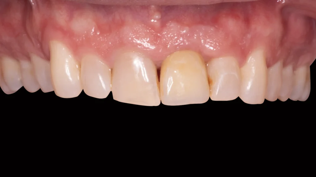 Digital Smile Design For Dental implants