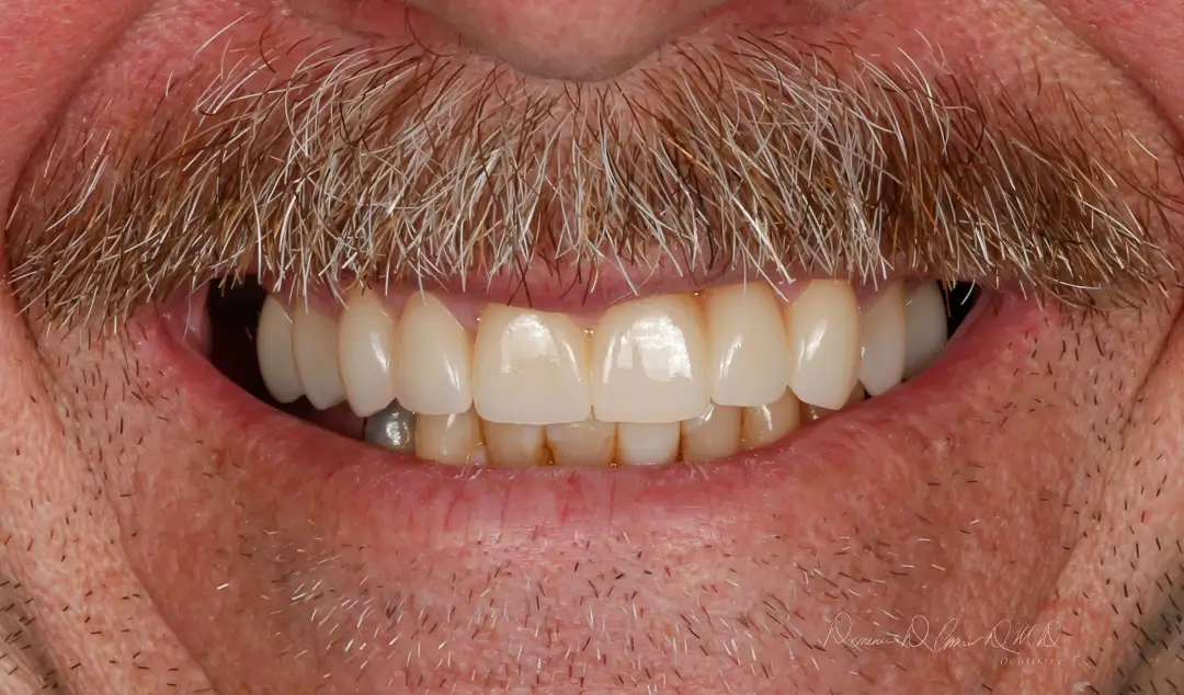 DAmico Dental Care - dental Implants in wayland & watertown - Our advanced dental implants in Wayland & Watertown, MA are a permanent, natural, and life-changing solution that feels and functions just like your own teeth — no slipping, no discomfort, no hesitation. Imagine chewing effortlessly, smiling freely, and knowing your face will stay youthful and strong for decades.