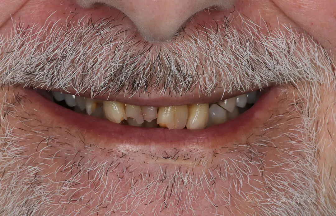 DAmico Dental Care - Porcelain Veneers - Porcelain Veneers are more than a cosmetic treatment — they are a life-enhancing upgrade in confidence, first impressions, and everyday happiness. Using advanced digital smile design and handcrafted porcelain artistry, we create a customized, natural-looking smile that lasts for years and reflects your personality, facial harmony, and aesthetic goals.