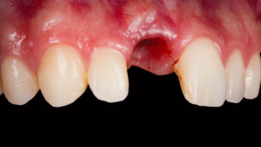 Before Image - Healing Dental implants process