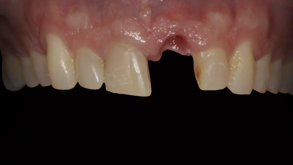 dental implants procedure in Wayland & Watertown, MA