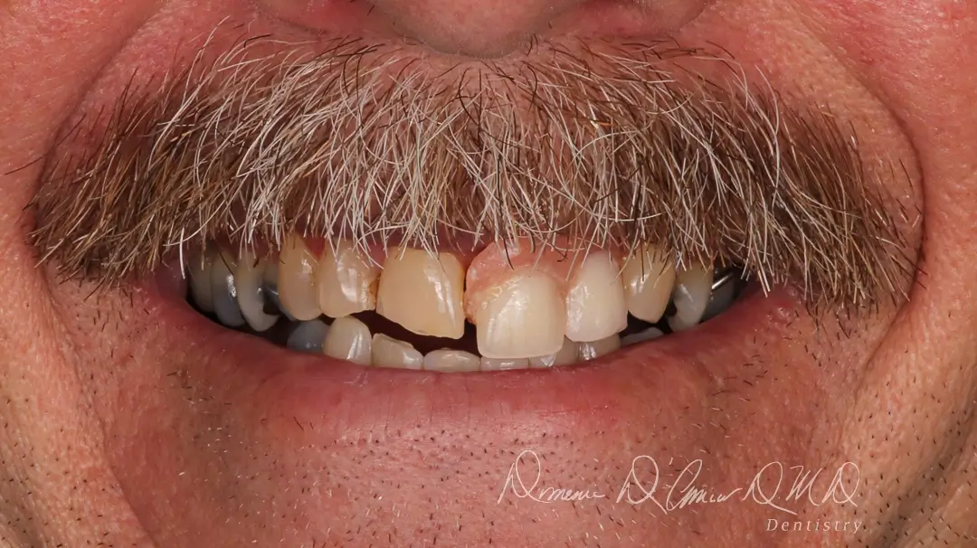 DAmico Dental Care - dental Implants in wayland & watertown - Our advanced dental implants in Wayland & Watertown, MA are a permanent, natural, and life-changing solution that feels and functions just like your own teeth — no slipping, no discomfort, no hesitation. Imagine chewing effortlessly, smiling freely, and knowing your face will stay youthful and strong for decades.