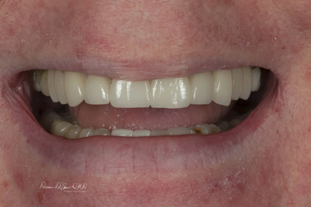 Porcelain Veneers