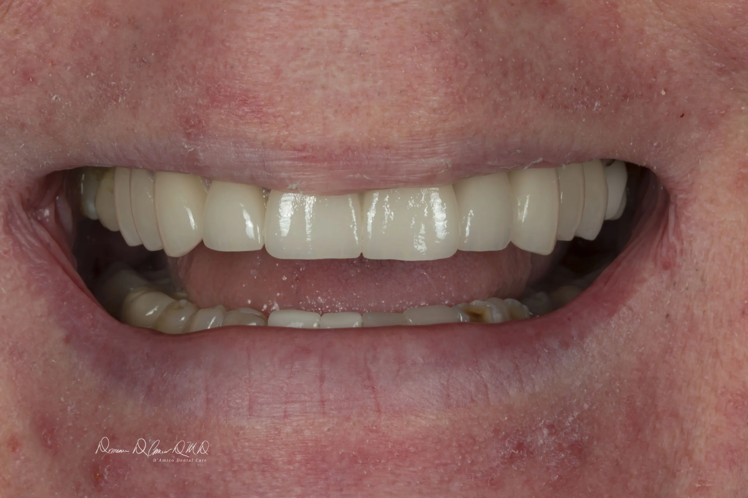 Porcelain Veneers