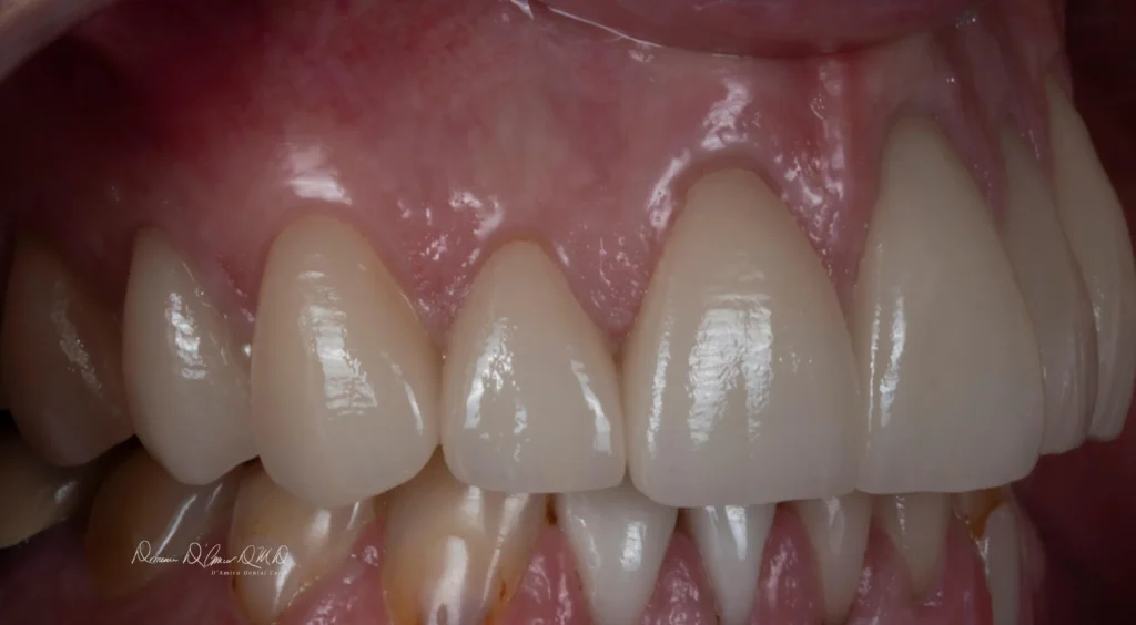 DAmico Dental Care - Porcelain Veneers - Porcelain Veneers are more than a cosmetic treatment — they are a life-enhancing upgrade in confidence, first impressions, and everyday happiness. Using advanced digital smile design and handcrafted porcelain artistry, we create a customized, natural-looking smile that lasts for years and reflects your personality, facial harmony, and aesthetic goals.