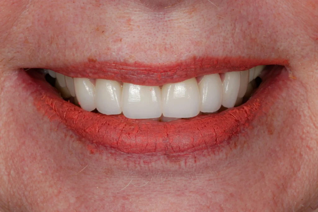 DAmico Dental Care - Bone Grafting - Delay bone grafting and the loss compounds: