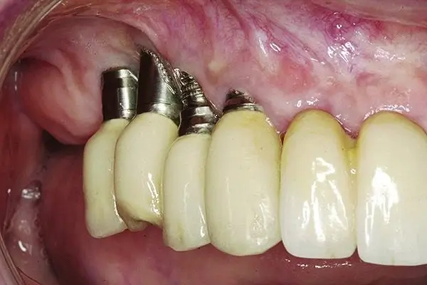 Factors Affecting Your Implant Costs