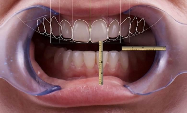 Laser gum contouring