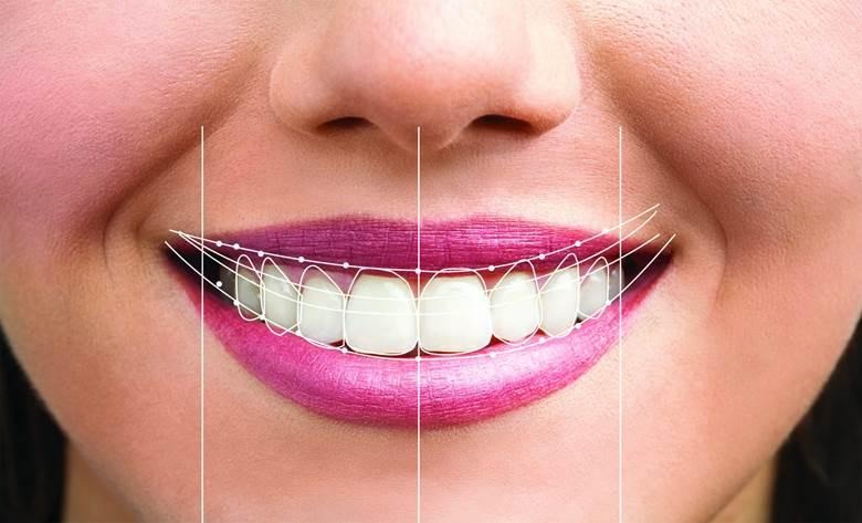 am i good candidate for veneers?