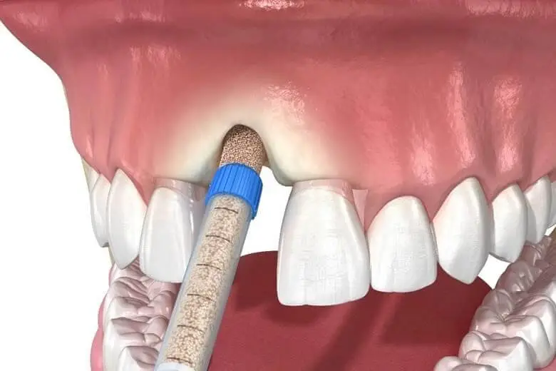 why bone grafting is necessary for dental implants