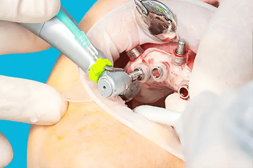 DAmico Dental Care - Safer Dental Implant Placement - This approach transforms implant placement into an entirely predictable process. Using CBCT 3D scans and sophisticated digital planning software, we design your entire surgical blueprint before treatment begins. This means unparalleled precision, minimal invasiveness, and the highest safety factor, leading to a safer dental implant placement. We use this virtual plan to create a custom Surgical Guide that acts like a GPS for your procedure, ensuring precise implant placement. In the following section, we will explain in full how this revolutionary technology virtually eliminates the risk of damage to nerves, sinuses, and adjacent tissues, delivering a confident and worry-free experience for you.