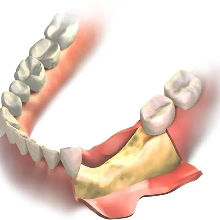 tooth loss treatment and healing dentistry in wayland and watertown