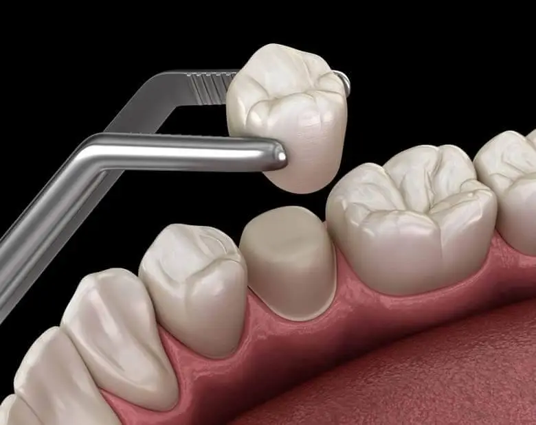 Protecting Your Smile: How to Maintain Your CEREC Crown