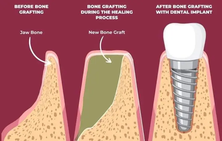 good candidate for bone grafting