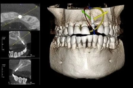 DAmico Dental Care - Safer Dental Implant Placement - This approach transforms implant placement into an entirely predictable process. Using CBCT 3D scans and sophisticated digital planning software, we design your entire surgical blueprint before treatment begins. This means unparalleled precision, minimal invasiveness, and the highest safety factor, leading to a safer dental implant placement. We use this virtual plan to create a custom Surgical Guide that acts like a GPS for your procedure, ensuring precise implant placement. In the following section, we will explain in full how this revolutionary technology virtually eliminates the risk of damage to nerves, sinuses, and adjacent tissues, delivering a confident and worry-free experience for you.