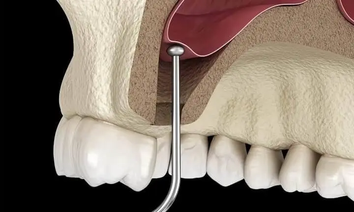 bone graft cost in watertown & wayland - materials