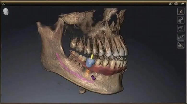DAmico Dental Care - Safer Dental Implant Placement - This approach transforms implant placement into an entirely predictable process. Using CBCT 3D scans and sophisticated digital planning software, we design your entire surgical blueprint before treatment begins. This means unparalleled precision, minimal invasiveness, and the highest safety factor, leading to a safer dental implant placement. We use this virtual plan to create a custom Surgical Guide that acts like a GPS for your procedure, ensuring precise implant placement. In the following section, we will explain in full how this revolutionary technology virtually eliminates the risk of damage to nerves, sinuses, and adjacent tissues, delivering a confident and worry-free experience for you.