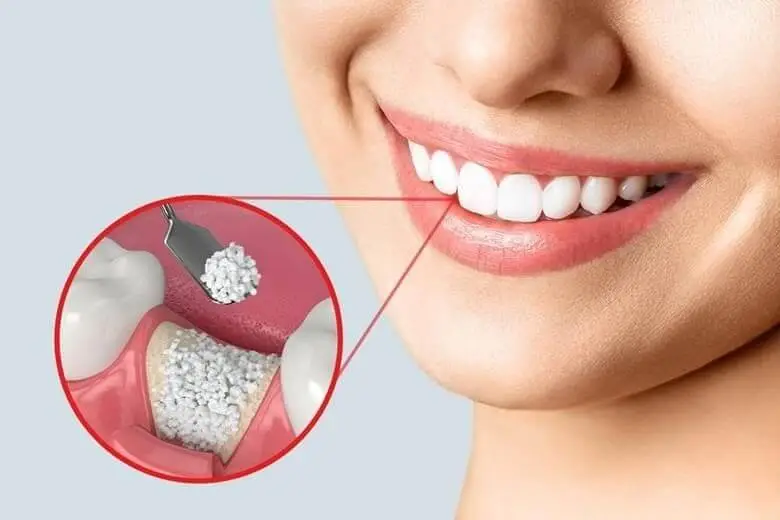 what is bone grafting