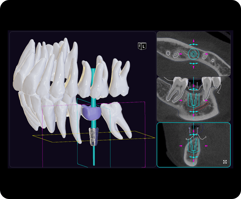 DAmico Dental Care - Safer Dental Implant Placement - This approach transforms implant placement into an entirely predictable process. Using CBCT 3D scans and sophisticated digital planning software, we design your entire surgical blueprint before treatment begins. This means unparalleled precision, minimal invasiveness, and the highest safety factor, leading to a safer dental implant placement. We use this virtual plan to create a custom Surgical Guide that acts like a GPS for your procedure, ensuring precise implant placement. In the following section, we will explain in full how this revolutionary technology virtually eliminates the risk of damage to nerves, sinuses, and adjacent tissues, delivering a confident and worry-free experience for you.
