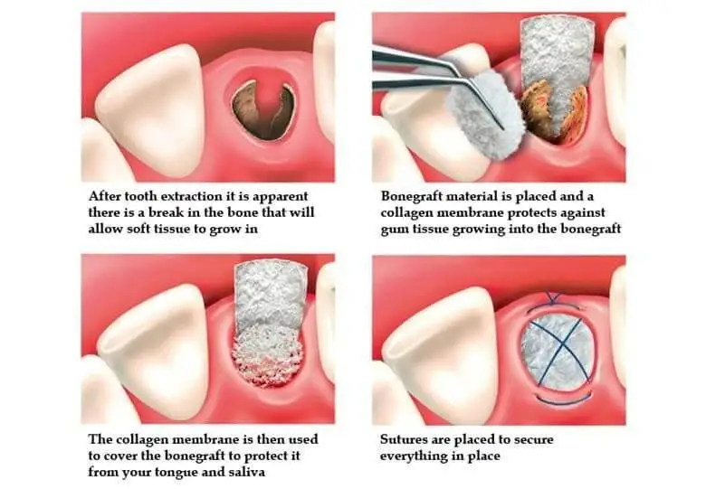 damico dental care for bone grafting treatment in watertown