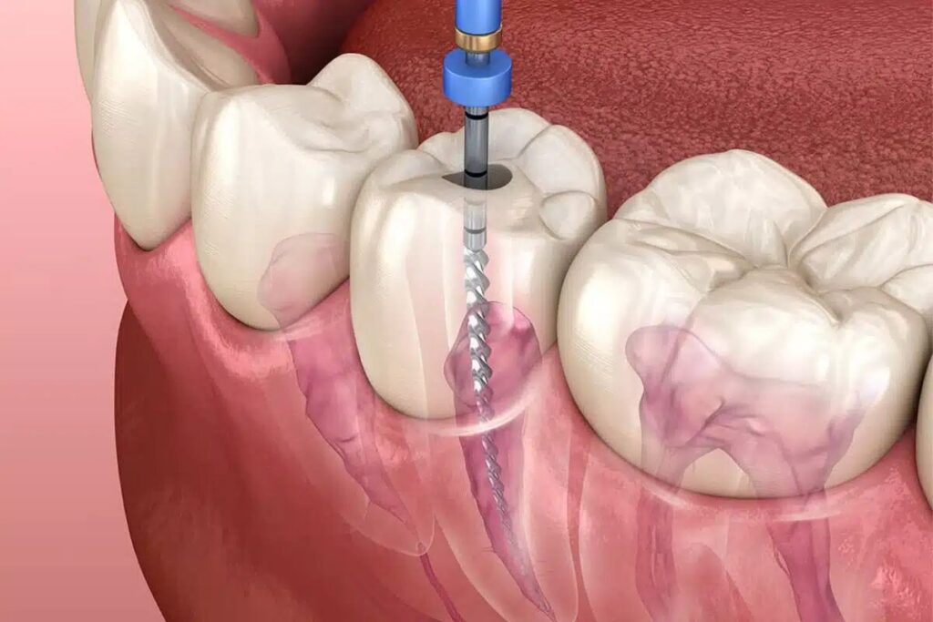 D'Amico Dental Care - Root Canal Treatment in 2025: Does It Really Hurt? Myths, Safety & the Truth You Should Know - Imagine walking into the dental office filled with fear and apprehension, wondering to yourself: "Does a root canal hurt? Will I feel everything? How difficult will the recovery be?" Now, imagine leaving your appointment thinking, "That was even more comfortable than a simple filling!" This is the reality of a root canal in 2025.