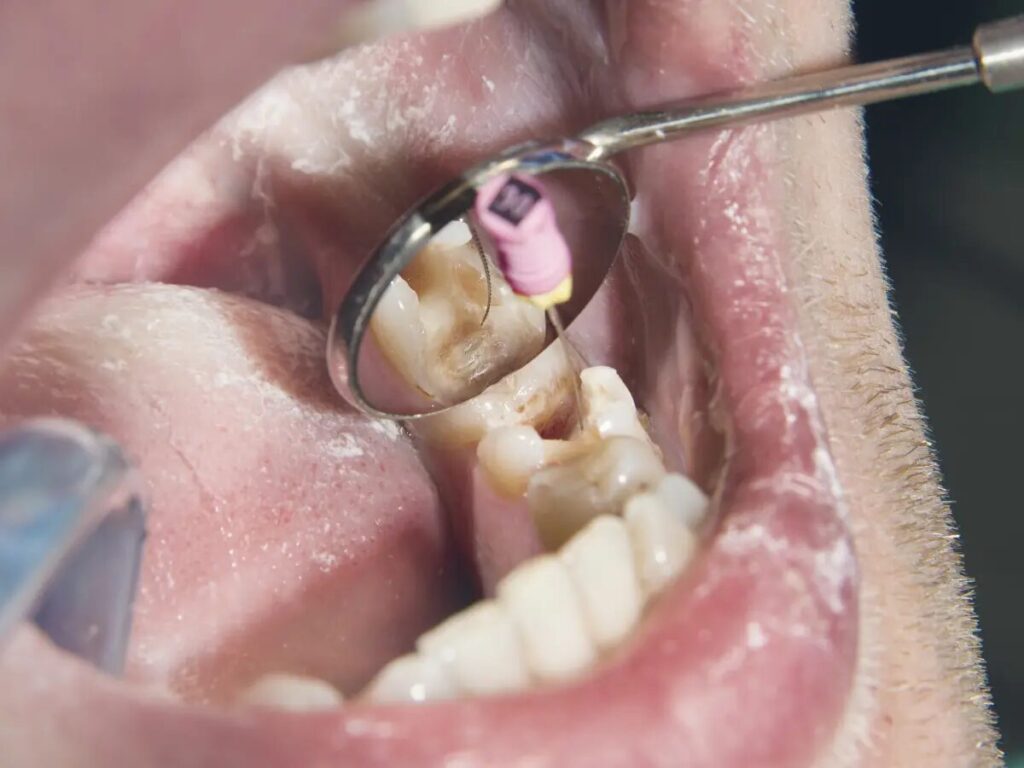 Protecting Your Teeth from Trauma