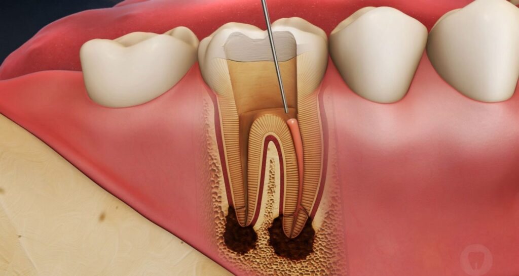 Root Canal Process in wayland & watertown