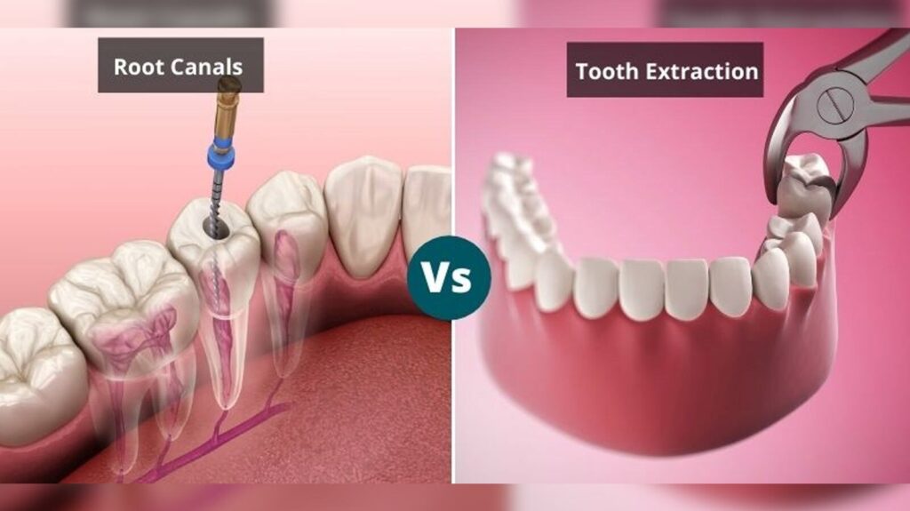 D'Amico Dental Care - Root Canal vs. Tooth Extraction: The Ultimate Guide to Saving Your Tooth, Cost, & Pain 2025 - A tooth is hurting, and you're faced with a significant decision: root canal vs extraction? Both methods solve the immediate problem, but their long-term impact on your oral health, smile aesthetics, and future costs is entirely different. If you're asking, "Which option is better for me?" you should know that the answer lies in the specific condition of your tooth and your personal priorities.