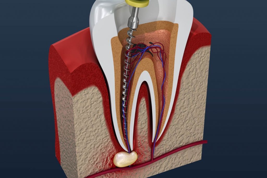 root canal treatment in Wayland & Watertown, MA