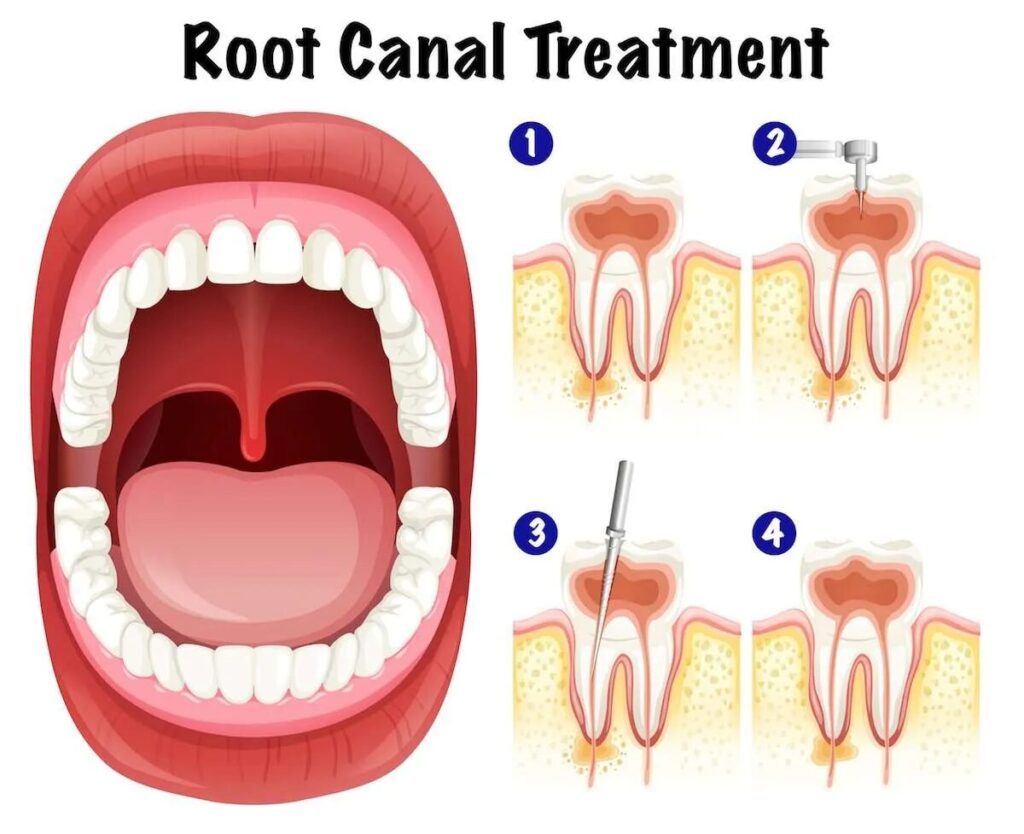 Root canal procedure in damico dental care in wayland and watertown, MA