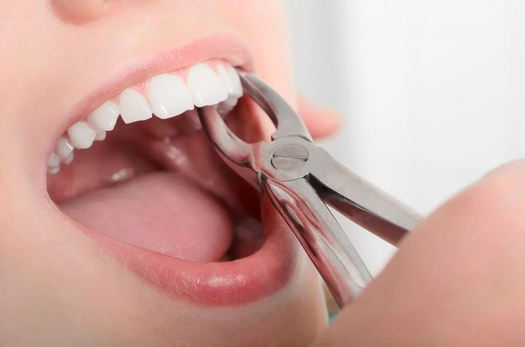 tooth extraction in Wayland & Watertown, MA in Damico dental care