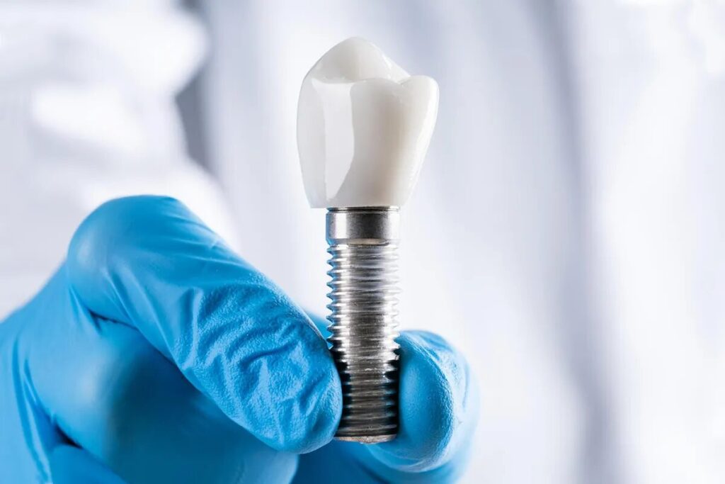 D'Amico Dental Care - How Cutting-Edge Digital Planning is Transforming Dental Implant Success in 2025: Precision, Safety, and Faster Recovery at D'Amico - Did you know that inadequate digital planning is one of the leading causes of dental implant failure? Today, with the advent of advanced digital technologies, this risk has been significantly reduced. At D'Amico Dental in Wayland and Watertown, we have transformed implant placement into a precise, predictable, and thoroughly calculated process. Using 3D implant planning, every step of the treatment is designed with micron-level accuracy to achieve the best possible outcome.