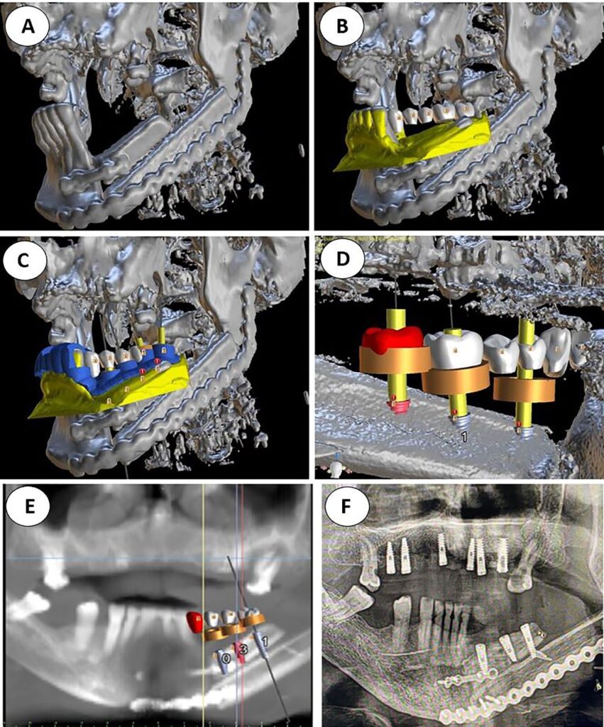 D'Amico Dental Care - How Cutting-Edge Digital Planning is Transforming Dental Implant Success in 2025: Precision, Safety, and Faster Recovery at D'Amico - Did you know that inadequate digital planning is one of the leading causes of dental implant failure? Today, with the advent of advanced digital technologies, this risk has been significantly reduced. At D'Amico Dental in Wayland and Watertown, we have transformed implant placement into a precise, predictable, and thoroughly calculated process. Using 3D implant planning, every step of the treatment is designed with micron-level accuracy to achieve the best possible outcome.