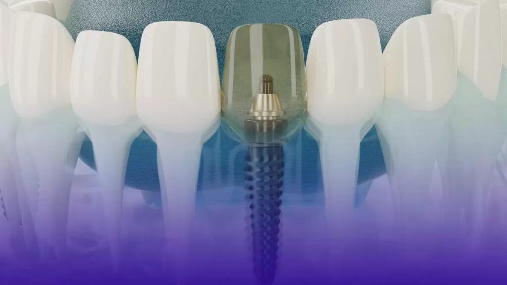 D'Amico Dental Care - Overcoming Dental Implant Anxiety Before Getting a Implant in Wayland & Watertown: Expert Tips for a Calm, Confident Experience - Does the thought of getting a dental implant trigger anxiety or make you feel tense and worried? You’re not alone — millions of patients experience the same fear. The good news is that modern advancements in dental technology and techniques have transformed implants into a precise, predictable, and minimally invasive procedure. At D'Amico Dental Care in Watertown and Wayland, we understand that managing your peace of mind is just as important as restoring your smile.
