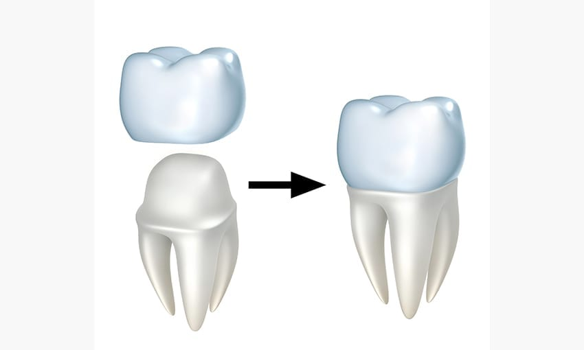 cerec same day crown cost in watertown, ma
