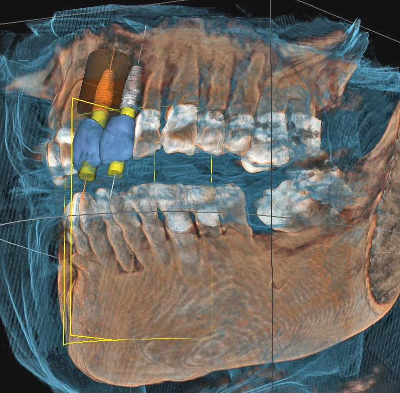 D'Amico Dental Care - Complex Implant Cases - Home / Page