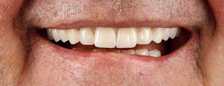 Fixed full-arch implant bridge in place after All-on-4 treatment