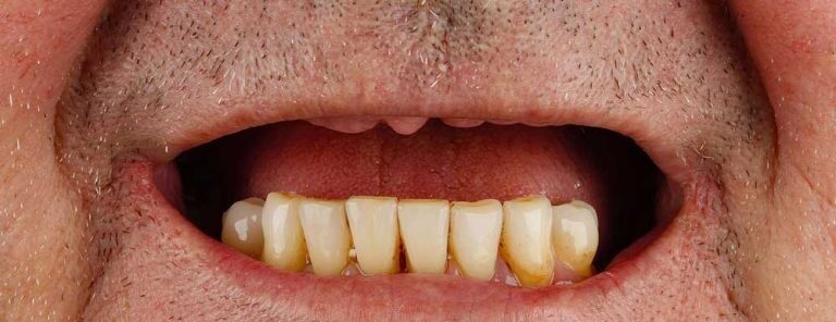 Failing upper dentition before All-on-4 full-arch implant treatment