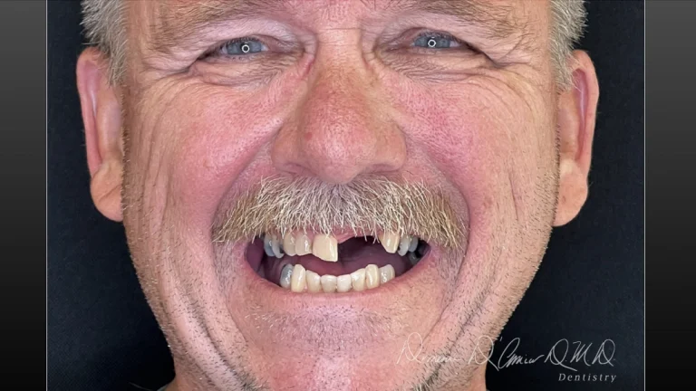D'Amico Dental Care - General Dentistry - We understand that choosing a dental practice is not about finding a clinic — it is about deciding where you place your trust.If you have specific concerns about your oral health, long-term outcomes, or the fear of making the wrong decision, you are not alone.We have guided hundreds of patients with similar questions, expectations, and priorities through carefully structured dental care.At D’Amico Dental Care, General Dentistry is not a collection of isolated treatments.It is a deliberate system, designed to provide clarity, continuity, and dependable outcomes — for patients of all ages.