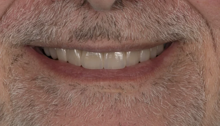 After veneer treatment
