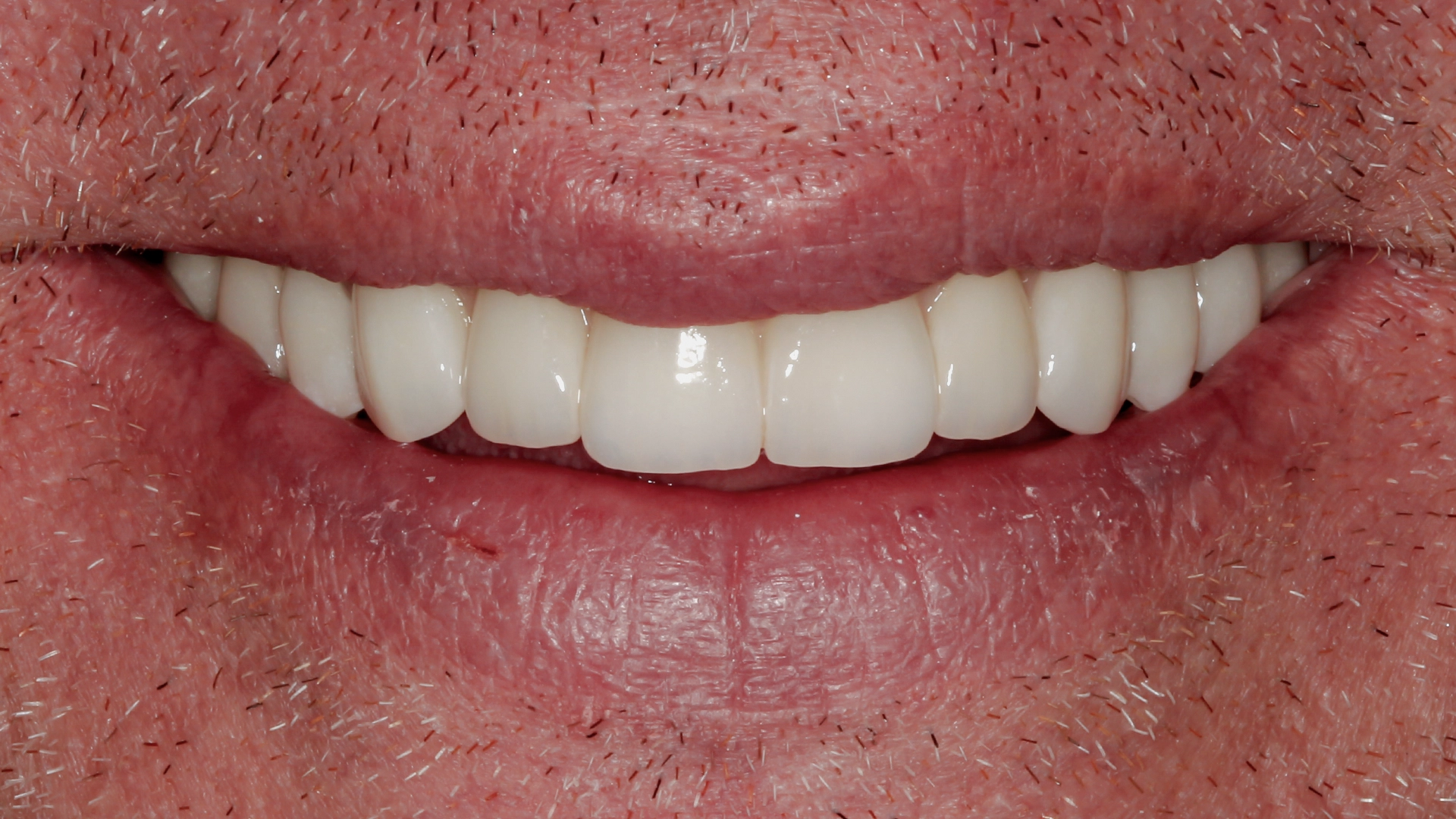 After dental implant treatment showing long-term natural result — D'Amico Dental Care implant restoration outcome