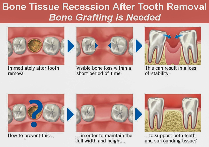 D'Amico Dental Care - Bone Graft & Soft Tissue Graft for Dental Implants - — Predictable Results in Complex Cases