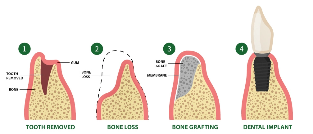 D'Amico Dental Care - Bone Graft & Soft Tissue Graft for Dental Implants - — Predictable Results in Complex Cases
