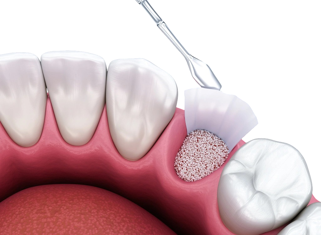 bone grafting wayland and watertown