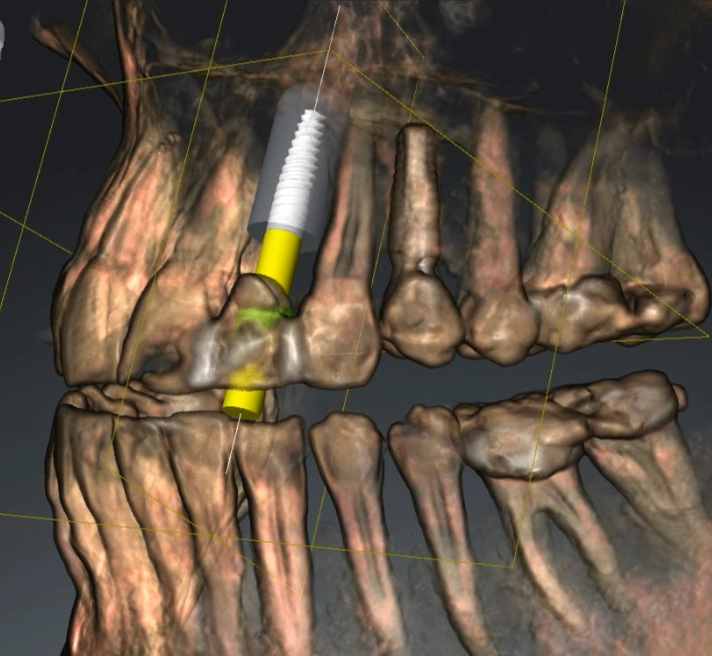 D'Amico Dental Care - Expert Planning for Complex Implants | D’Amico Dental Care - When implant treatment is described as “complex,” patients usually feel one thing before anything else: uncertainty.At D’Amico Dental Care, complex implant cases are approached with a fundamentally different mindset.More precise.More structured.More predictable before treatment begins.This page exists to explain how predictability is built, step by step, before any irreversible decision is made.