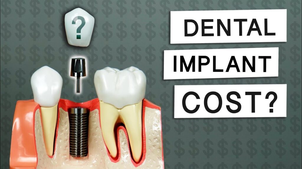 dental implants costs